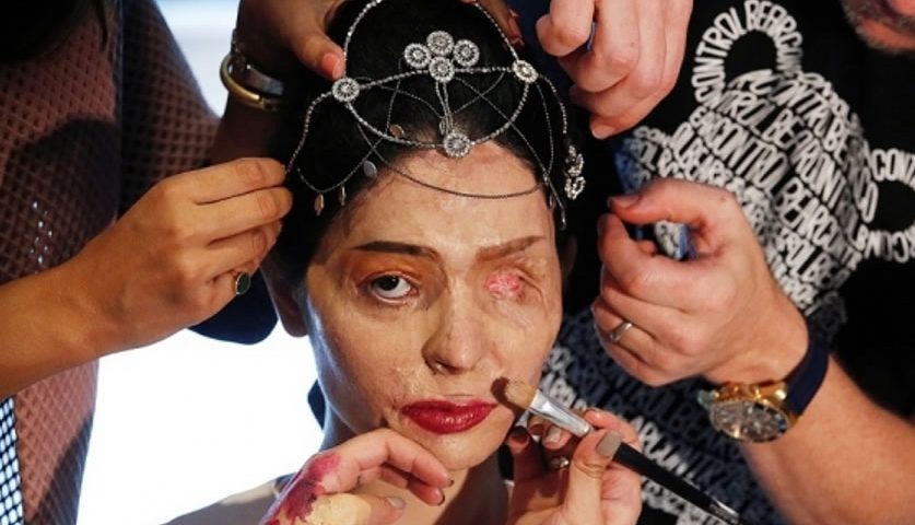 Indiana com rosto desfigurado desafia os padrões de beleza em desfile de moda